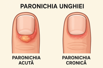 Paronichia unghiei