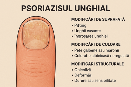 Psoriazisul unghial