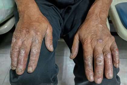 Al doilea caz de lepră Cluj